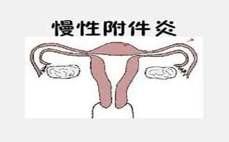 女性慢性附件炎能自己治愈吗